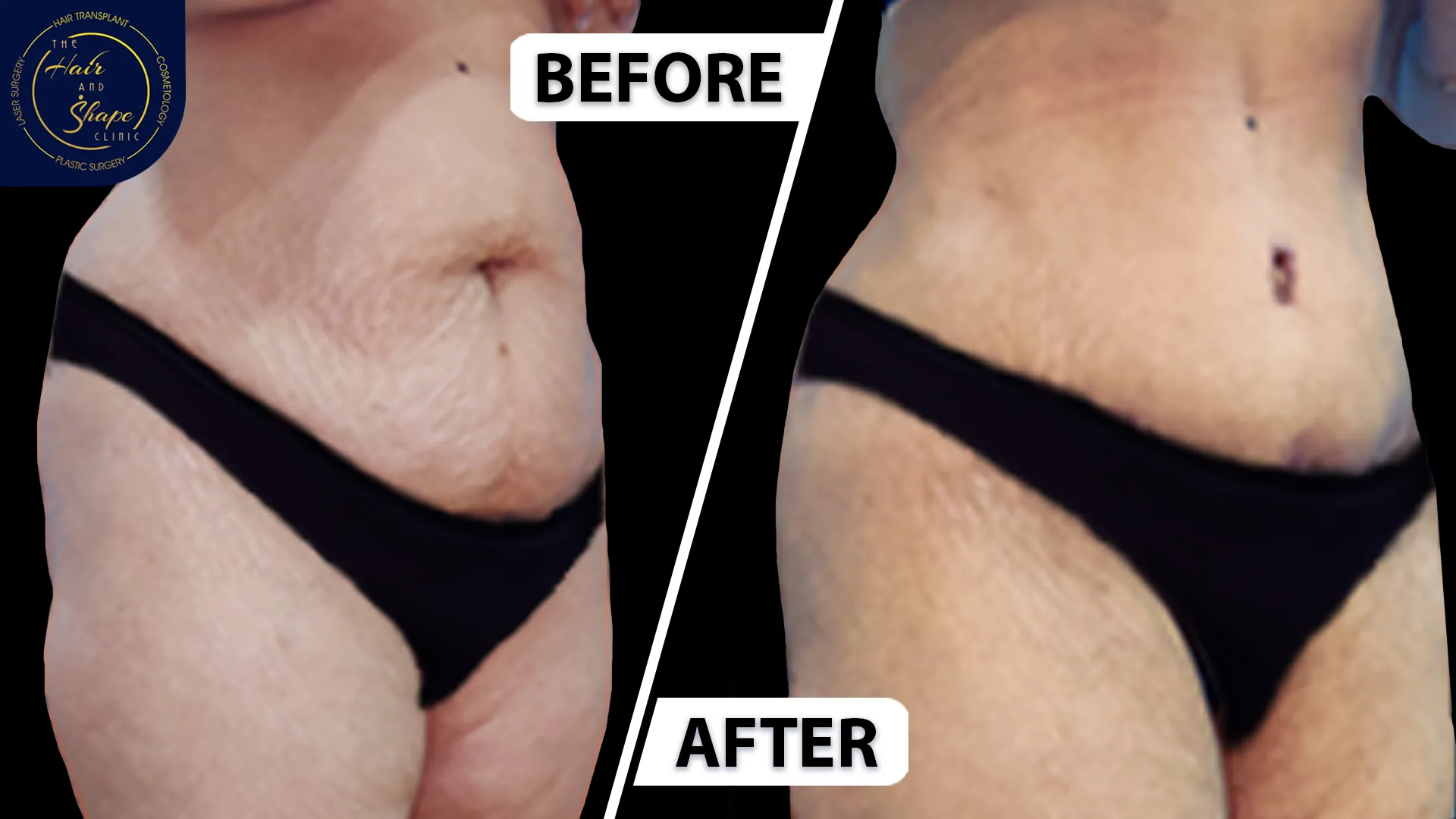 Tummy Tuck result8